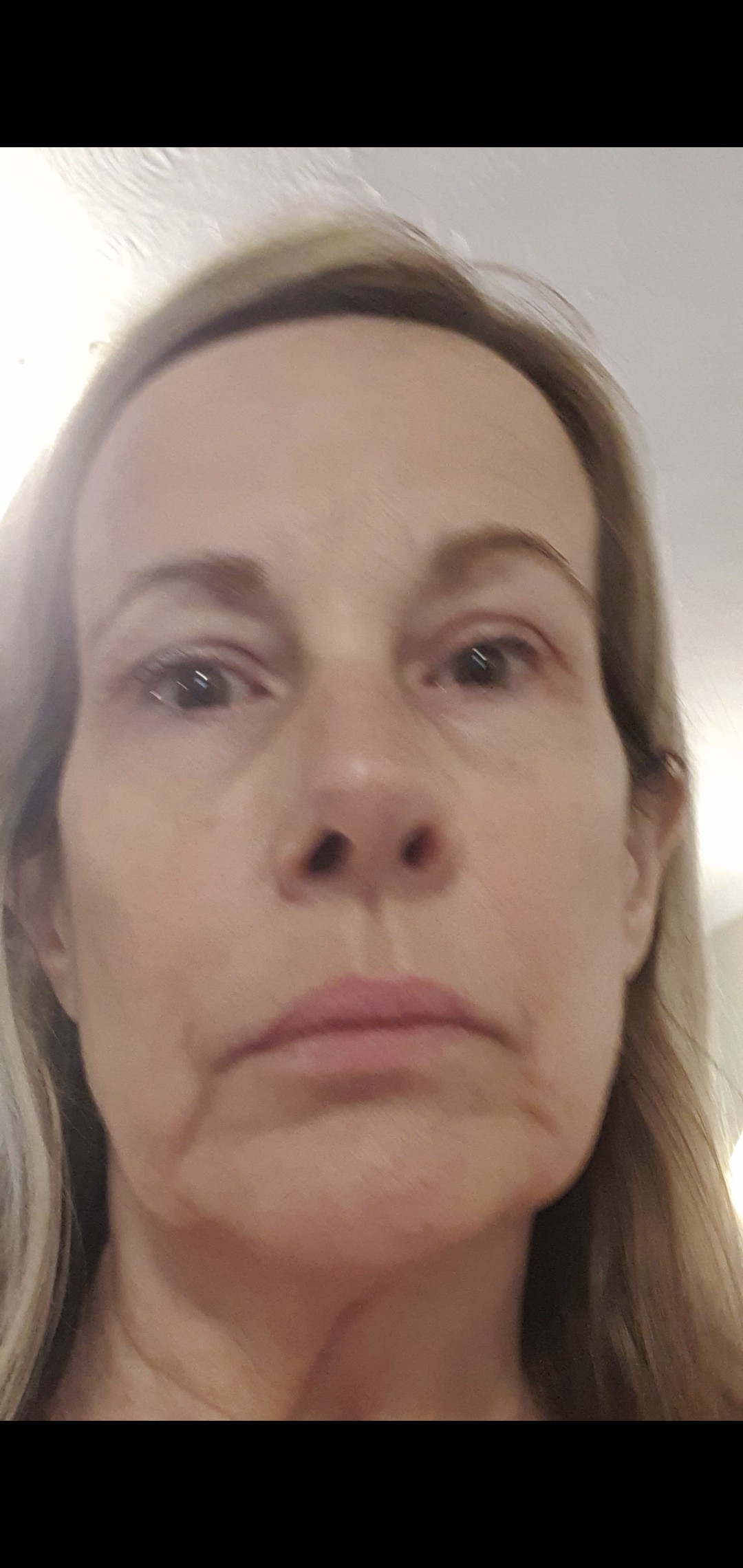 Facial Resurfacing After
